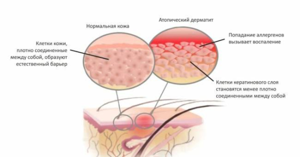 Роль витамина D в лечении атопического дерматита